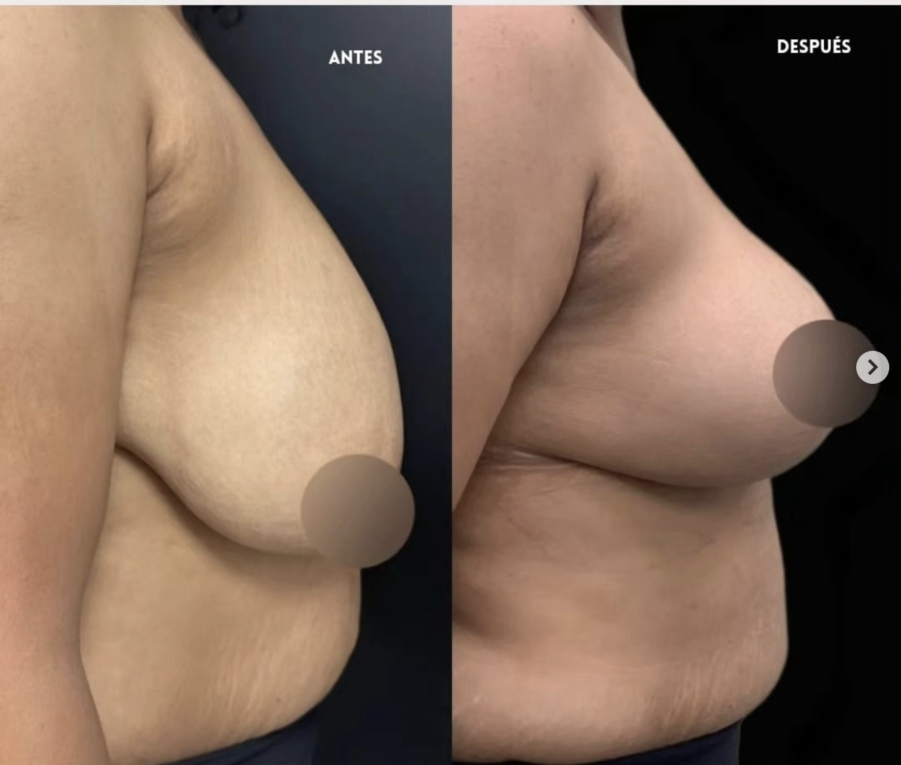Lipoescultura